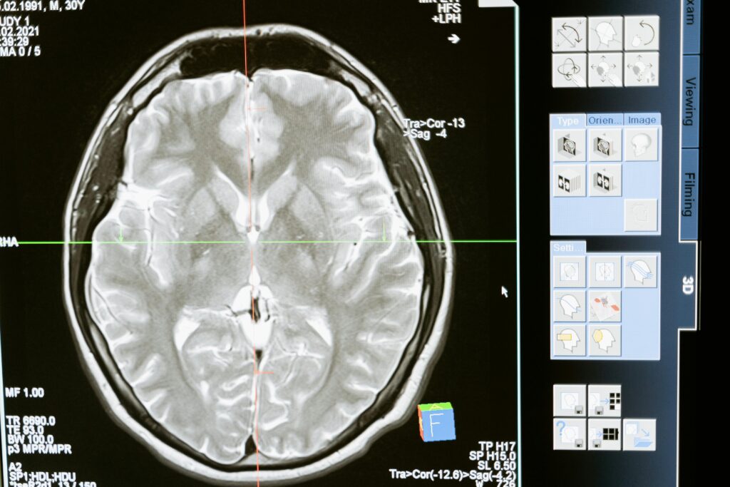 All You Need to Know About High-Functioning Schizophrenia